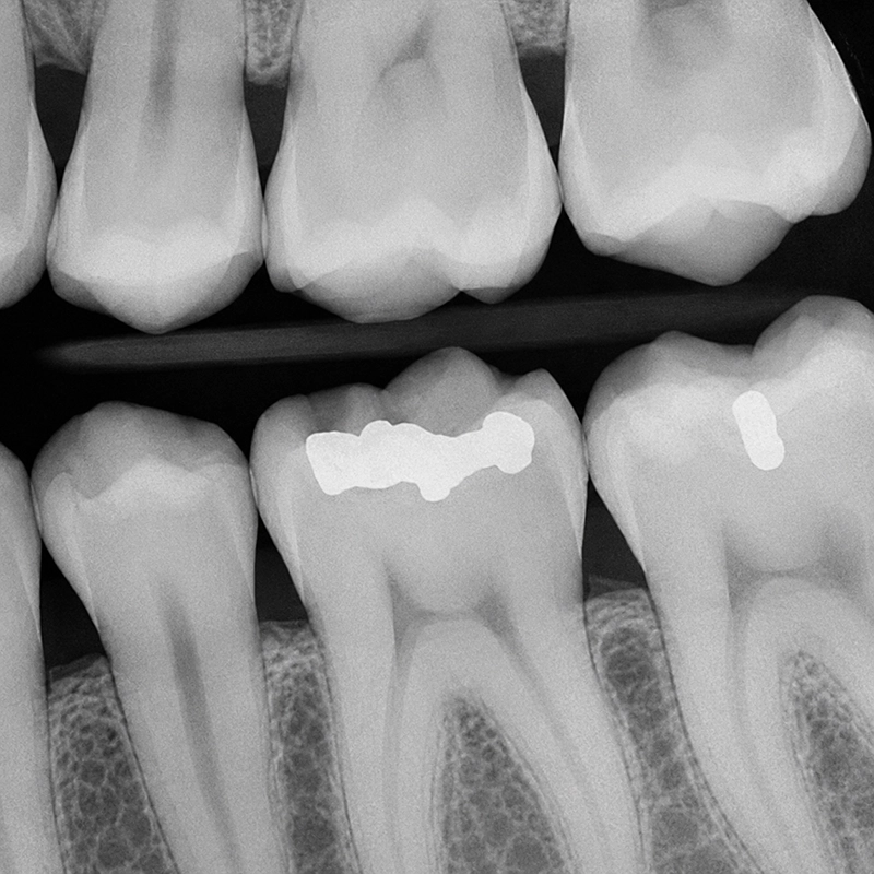 Advanced Digital Dental X-Ray Technology Modern digital dental X-ray infographic showing panoramic dental radiograph with cavities, bone loss, impacted teeth, and advanced dental imaging technology