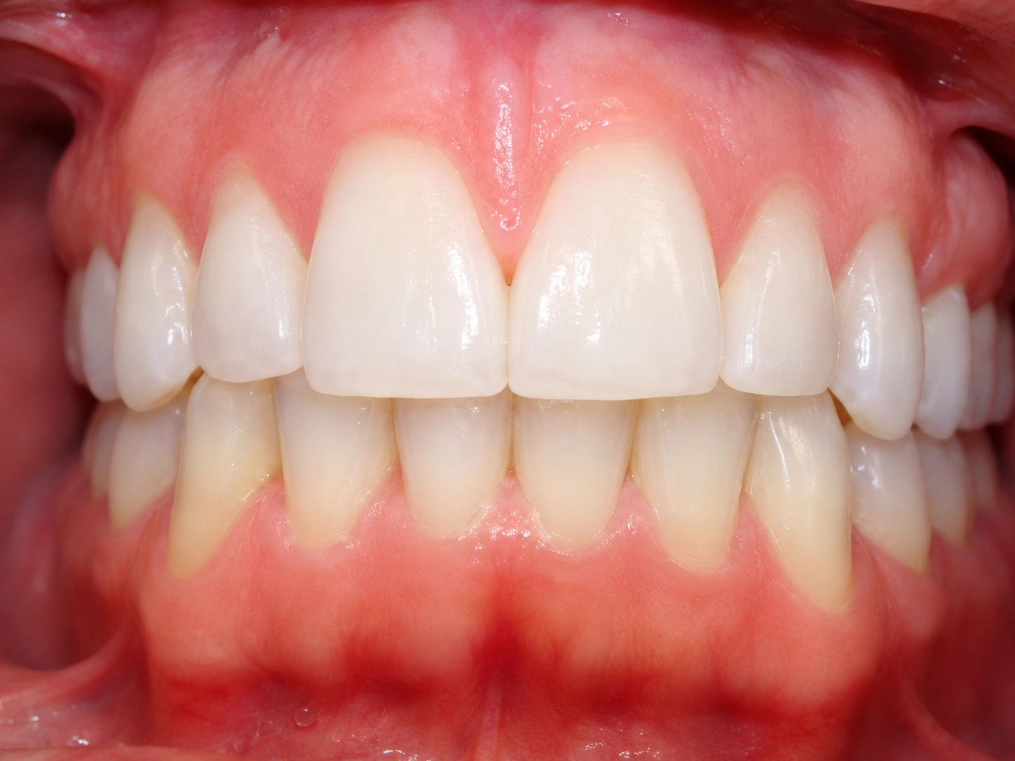 Real Invisalign® before and after smile transformation showing improved tooth alignment and enhanced smile aesthetics with clear aligners.