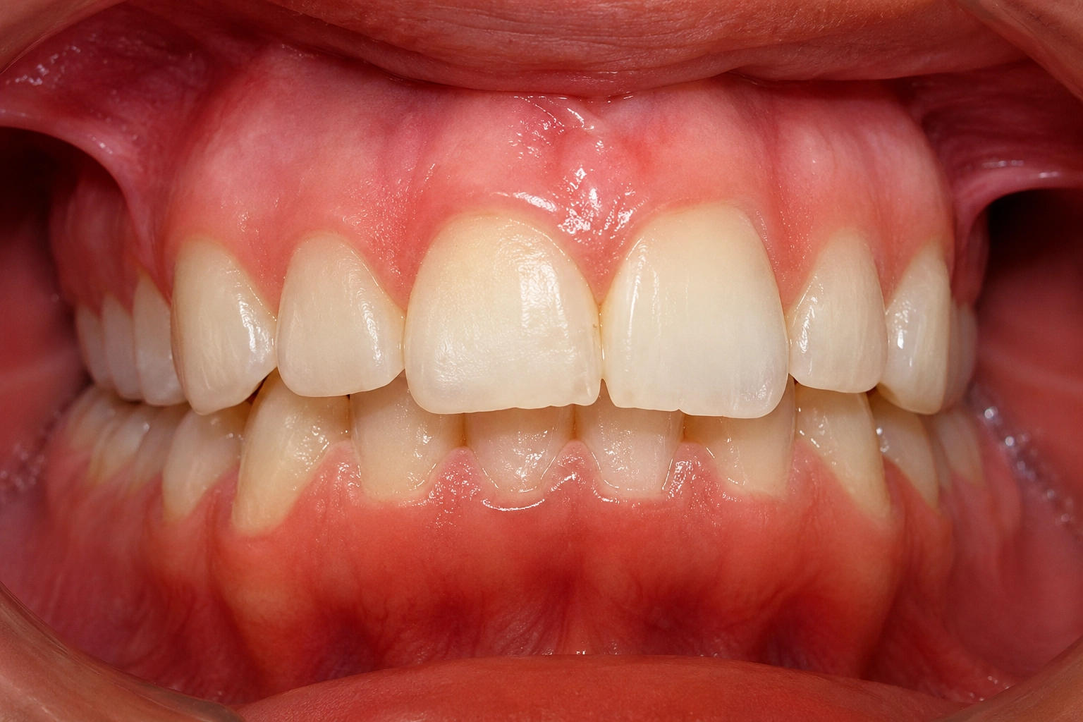 Invisalign® After Smile Transformation 11