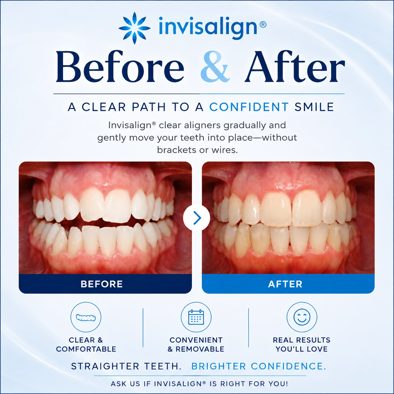 Invisalign® before and after smile transformation showing corrected tooth alignment and improved smile results with clear aligners at Peosta Dental.
