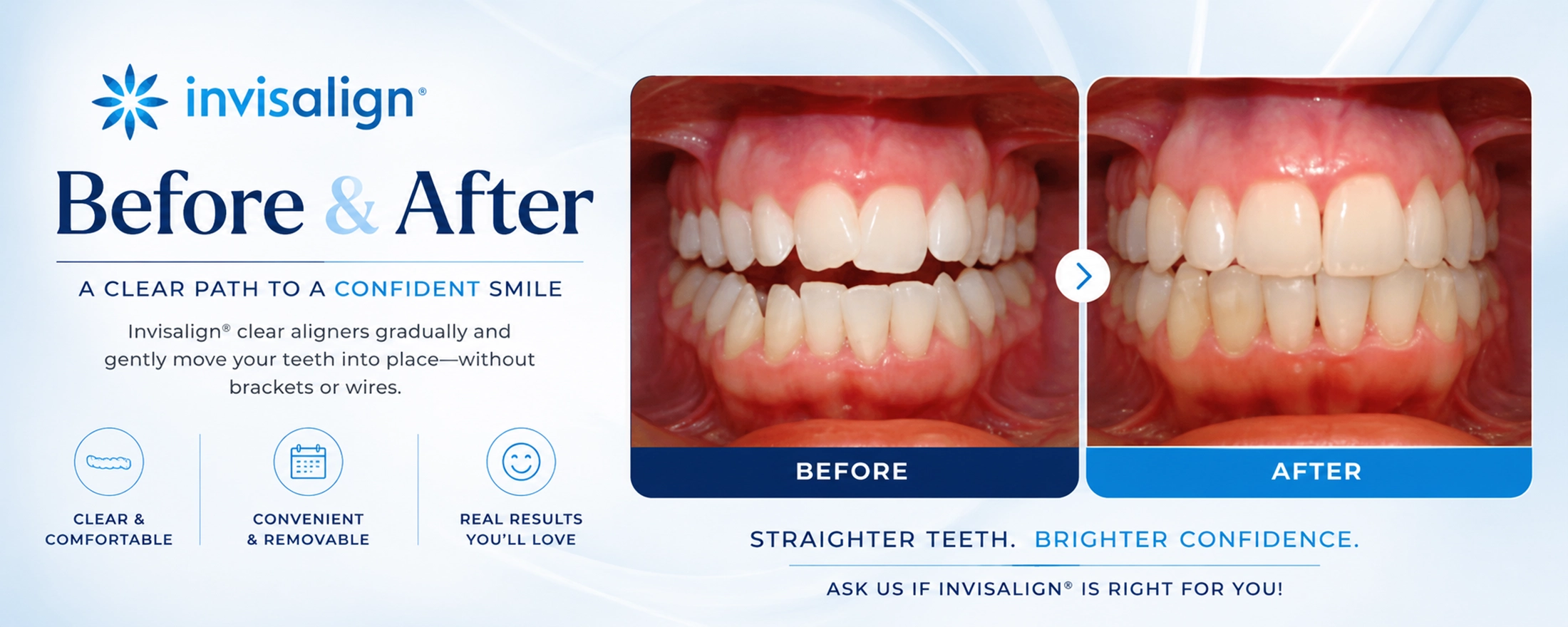 Invisalign® before and after smile transformation showing corrected tooth alignment and improved smile results with clear aligners at Peosta Dental.