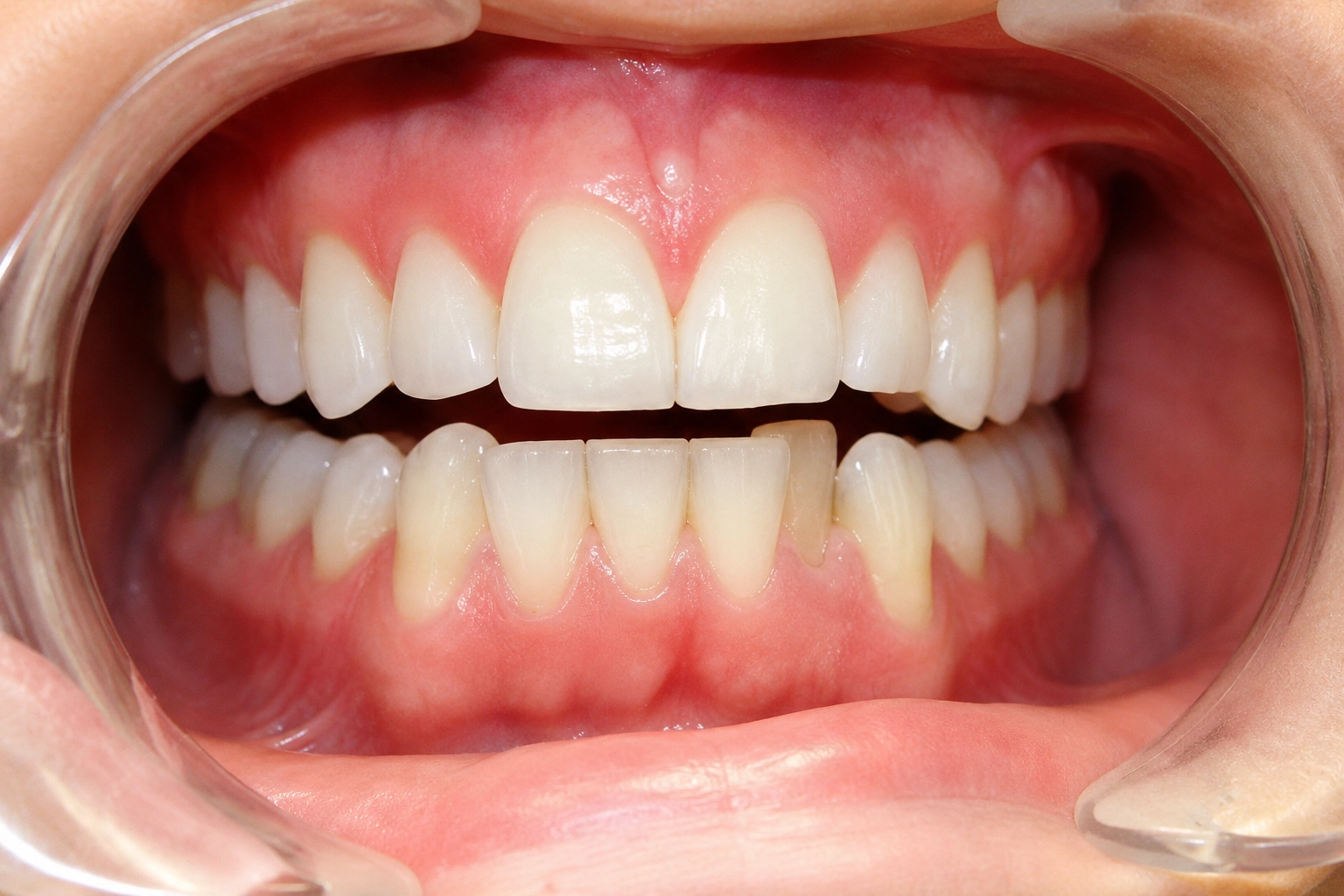 Real Invisalign® before and after smile transformation showing improved tooth alignment and enhanced smile aesthetics with clear aligners.