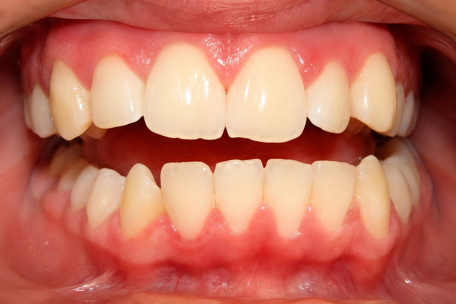Invisalign® Before Smile Transformation 08